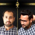 Discover 7 Key Facts About Non-Surgical Hair Replacement Services in the UAE