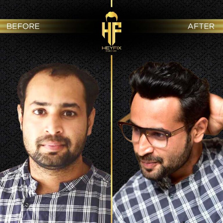 Discover 7 Key Facts About Non-Surgical Hair Replacement Services in the UAE