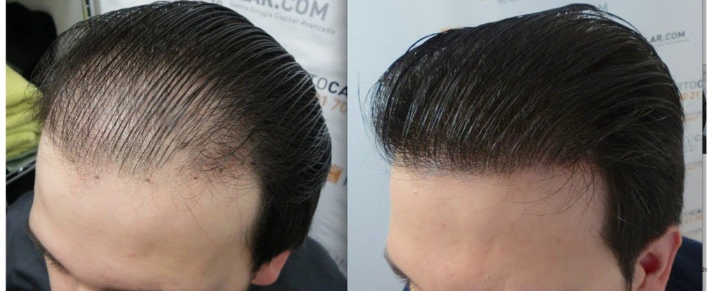 Hair System in Dubai