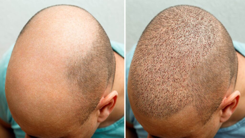 Non-surgical Hair Solutions