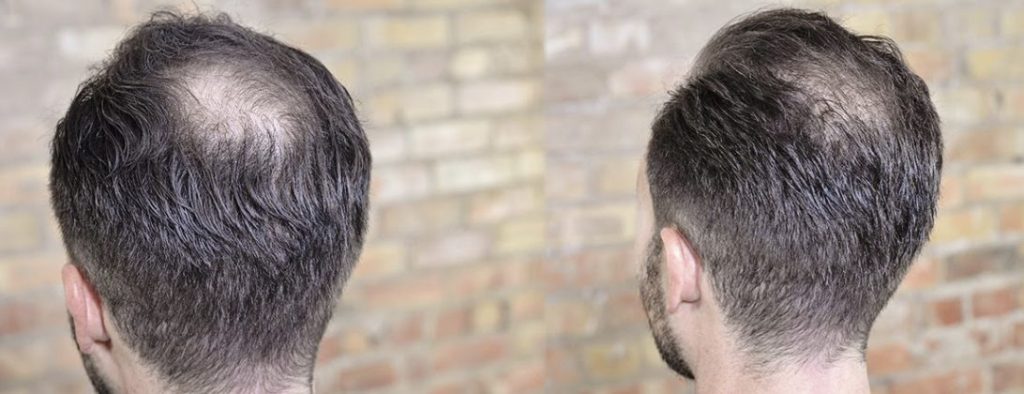 Hair Toppers