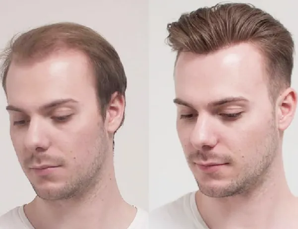 Are Hair Patches Safe for Your Real Hair? Find Out in Detail
