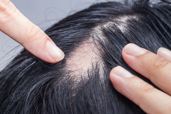 How Hair Patches Can Transform the Lives of Alopecia Patients