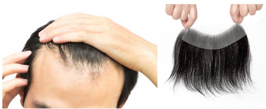 Hair Patches