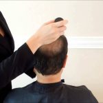 A Guide to Concealing Scars with Hair Patches and Toppers in Dubai