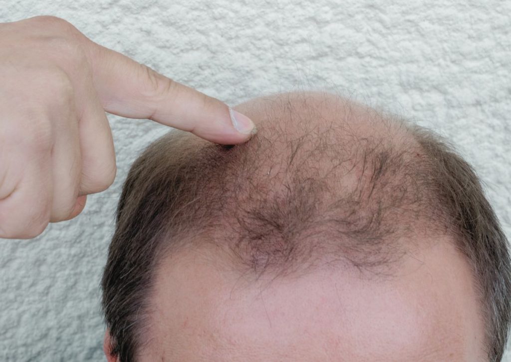 Hair Patches Dubai