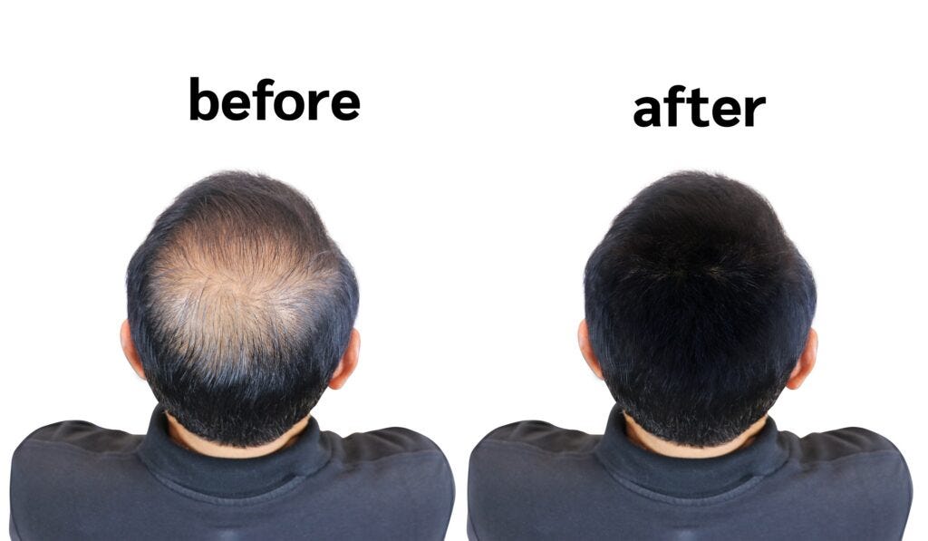 Men's Hair Patch