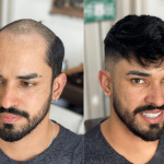 First Time Getting a Hair System in Dubai? Here’s Everything No One Tells You