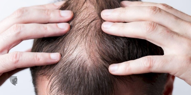 Hair Patch in Dubai