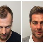 The Science Behind Hair Patches:  Why They’re Smarter Than Hair Transplants