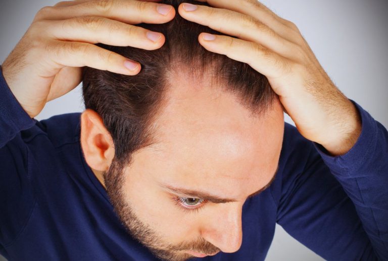 Signs Your Hair Patch Needs Refitting (Don’t Ignore These)