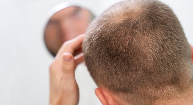 Why Hair Replacement Results Depend More on Fitting Than Hair Quality
