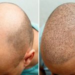 Is 25 Too Early for a Hair Transplant?&nbsp; Why a Hair Patch in Dubai Is the Smarter Choice for Young Men