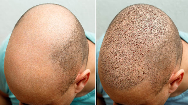hair-transplant