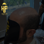 Top 5 Proven Hair Fall Treatments in Dubai to Restore Your Confidence