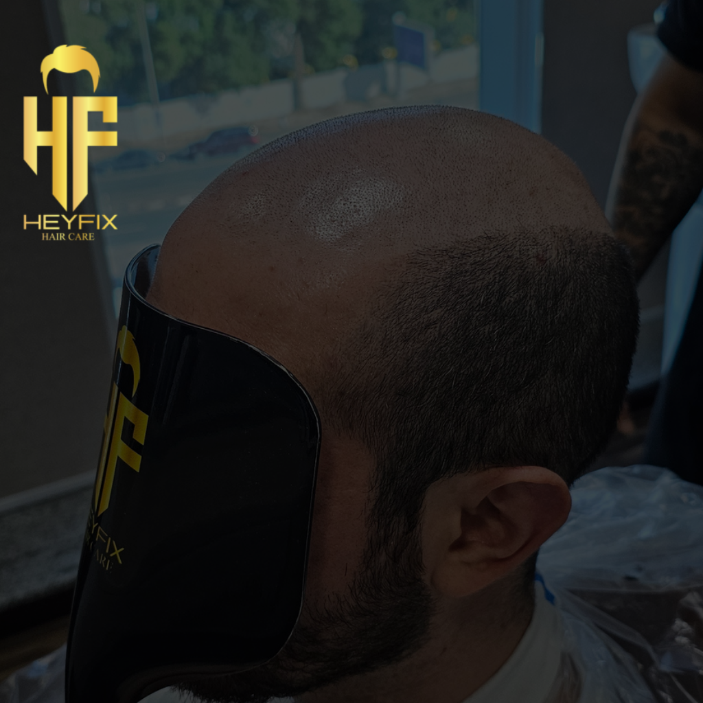 Hair Fall Treatment in Dubai